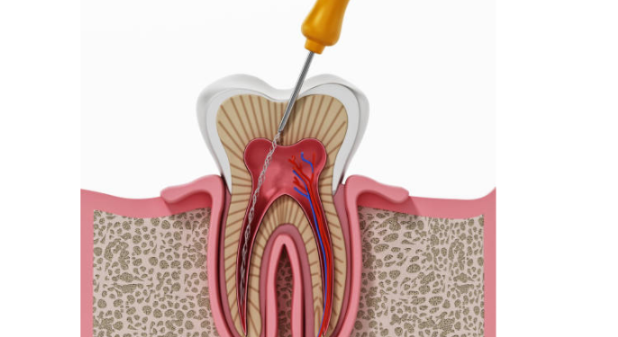What Are the Benefits of a Root Canal?