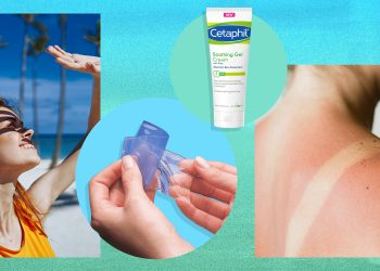 Can Sunburn Be Treated With Cream?