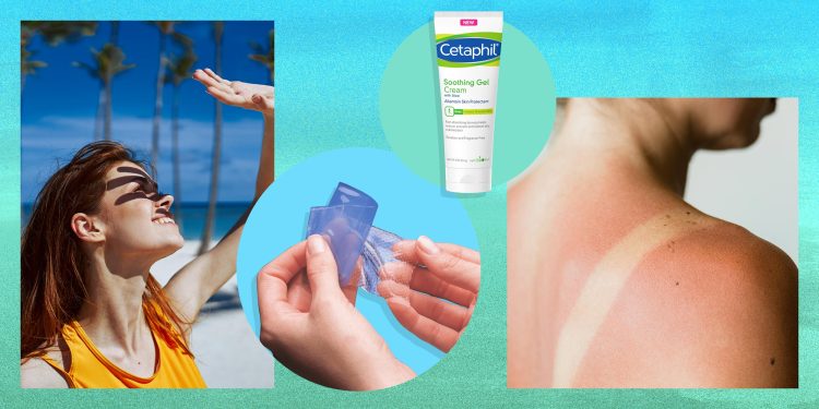 Can Sunburn Be Treated With Cream?
