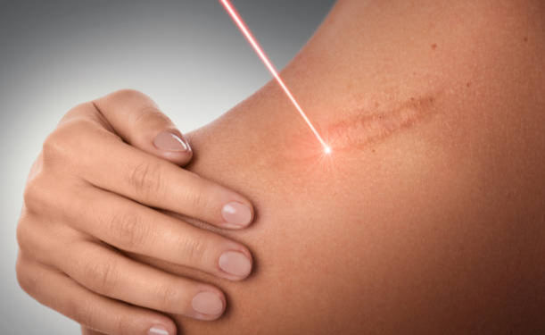 Benefits of Pro Yellow Laser