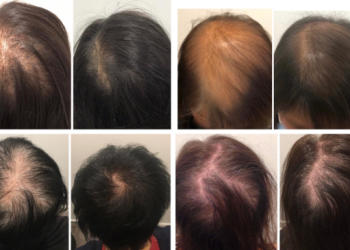 Say Goodbye to Hair Loss in Melbourne: Effective Solutions for your hair.