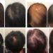 Say Goodbye to Hair Loss in Melbourne: Effective Solutions for your hair.
